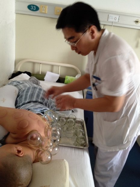 15 - Cupping alternated with acupuncture to treat severe back pain in a Buddhist nun in the hospital
